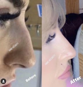 Anne Hegarty Cosmeticare - Non-Surgical Rhinoplasty