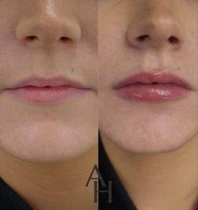 Anne Hegarty Cosmeticare - Lip Fillers